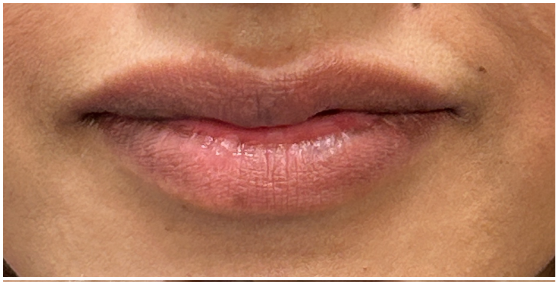 Lip Filler before — Thin Lips, Volume Loss, front view