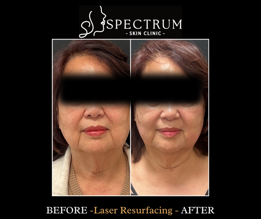 Laser Resurfacing Before & After | Lower Face and Neck Rejuvenation