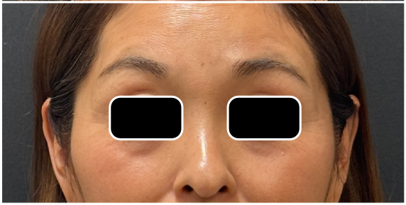 eMatrix after — fine-lines-wrinkles, sagging-laxity, enlarged-pores, front view