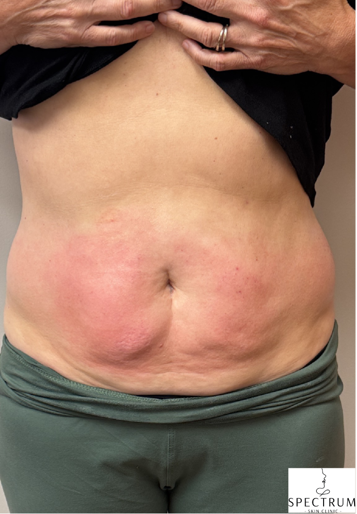 Body Cavitation after — Localized Fat, Body Contouring, Abdominal Fat, front view