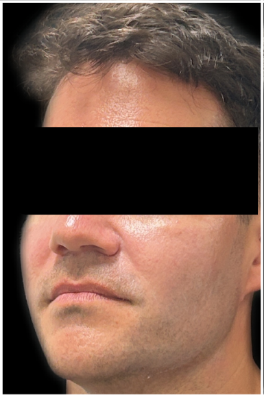 Jawline Filler, Cheek Filler, Facial Balancing before — Weak Jawline, Soft Lower Face, Lower Face Definition, Masculine Facial Definition, front view