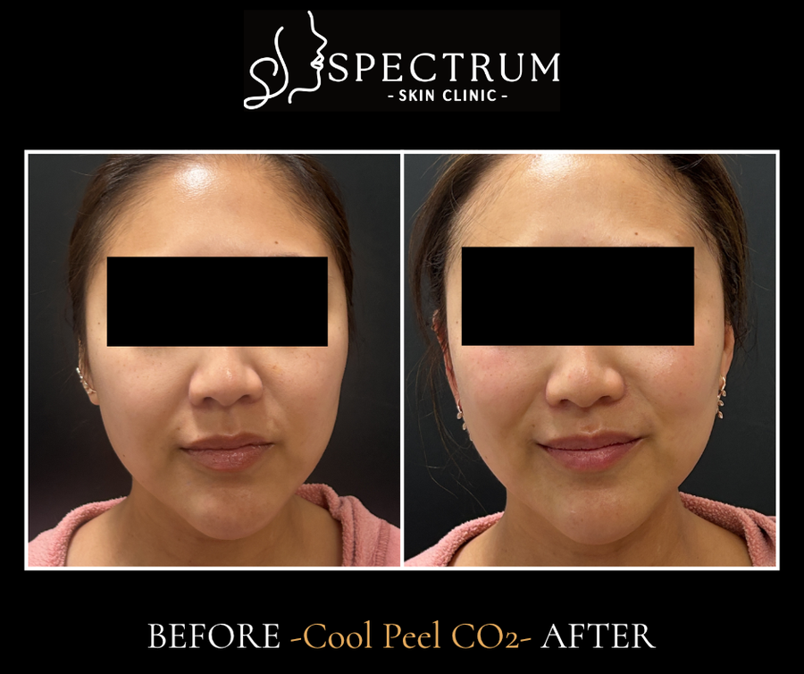 Cool Peel CO2 Before & After | Skin Texture, Tone and Enlarged Pores