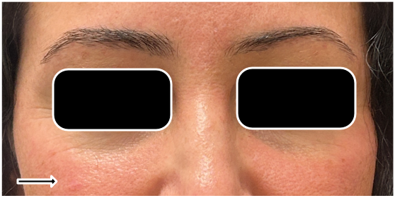 Filler Dissolve after — Under Eye Hollows, Under Eye Bags and Puffiness, Tear Trough, front view
