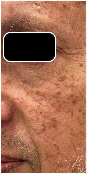 Q-Switch Nd:YAG Laser before — Sun Spots, Seborrheic Keratosis, Brown Spots, Sun Damage, front view
