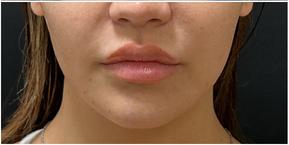 Lip Filler after — Thin Lips, front view
