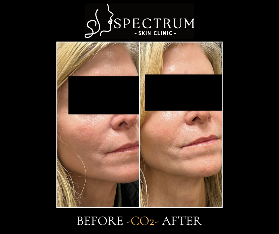 Perioral lines and surface texture, the kind of early-to-moderate presentation that responds well to laser resurfacing. Shown here on the CO2 platform; erbium addresses the same concern with a lighter recovery.