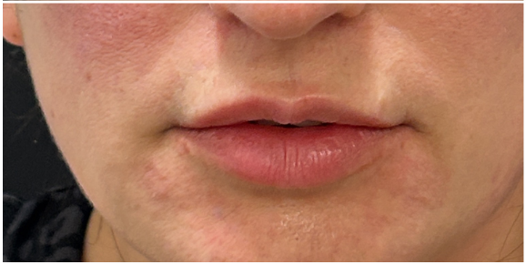 Lip Laser Plump after — Thin Lips, Perioral Aging, Lip Lines, Fine Lines, Wrinkles, front view