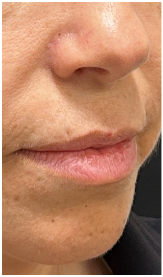 Lip Filler before — thin-lips, nasolabial-folds, front view