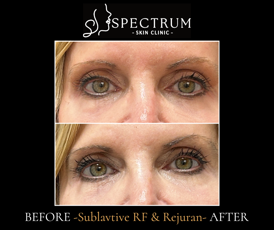 eMatrix Sublative RF Before & After | Under-Eye Skin Renewal