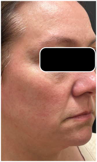 Light & Bright IPL after — Sun Damage, Hyperpigmentation, Uneven Skin Tone, Dullness, front view