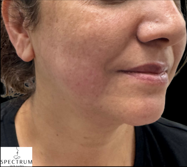 HIFU after — Sagging and Laxity, Lower Face Sagging, Jowling, front view