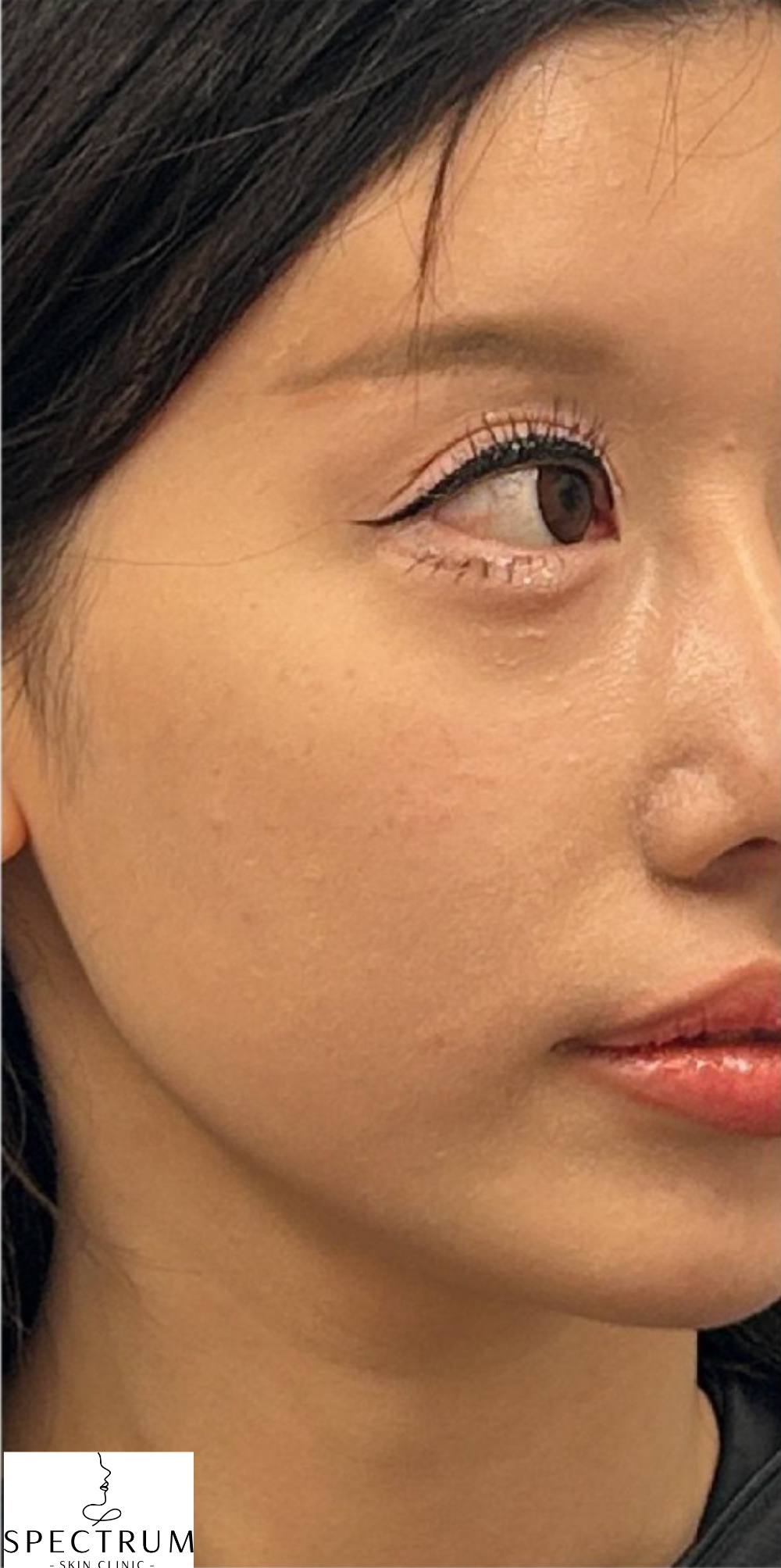 Filler Dissolve before — Filler Migration, Mid Face Heaviness, Pillow Face Appearance, Lower Face Heaviness, front view