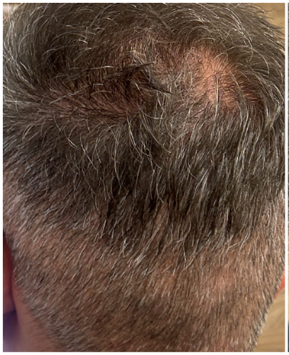 Exosome Hair Therapy before — Crown Thinning, Scalp Health, Reduced Hair Density, front view