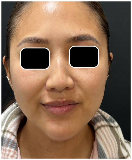 Cool Peel CO2 after — Dullness, Uneven Texture, Fine Lines, Sun Damage, Uneven Tone, front view