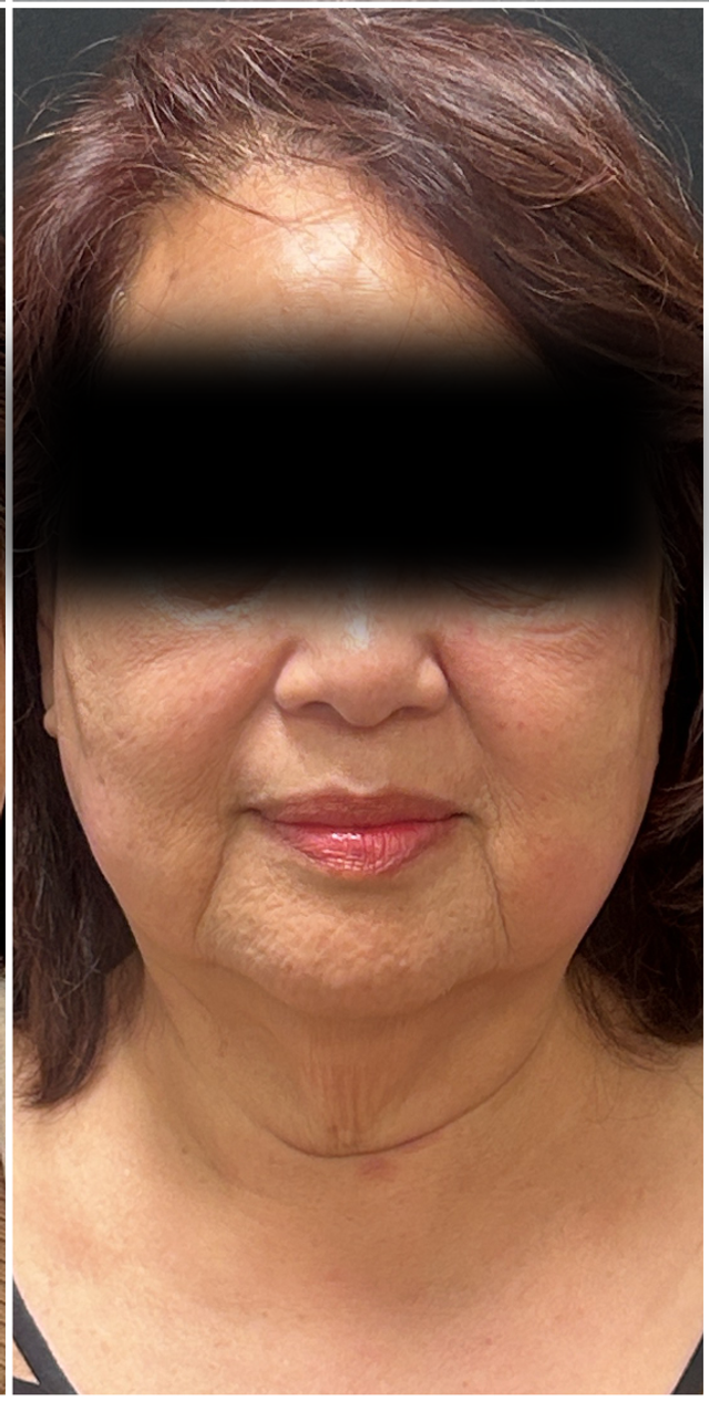 Laser Resurfacing Before & After | Lower Face and Neck Rejuvenation — after