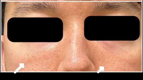 Candela PicoWay, Nd:YAG after — Enlarged Pores, Uneven Texture, Facial Redness, Skin Tone, front view
