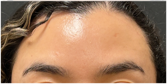 Botox Brow Lift after — Low Brows, Heavy Brows, Tired Eye Appearance, front view