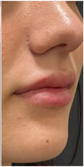 Lip Filler after — Thin Lips, front view