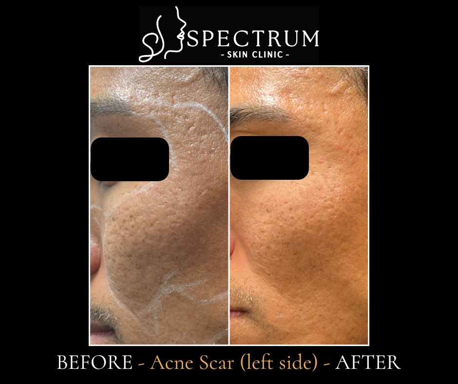 Acne Scar Before & After | CO2, Subcision and Rejuran (Left Side View)