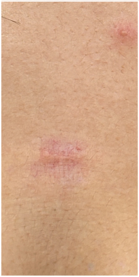 Intralesional Injection for Keloid after — Keloid Scar, Hypertrophic Scarring, front view