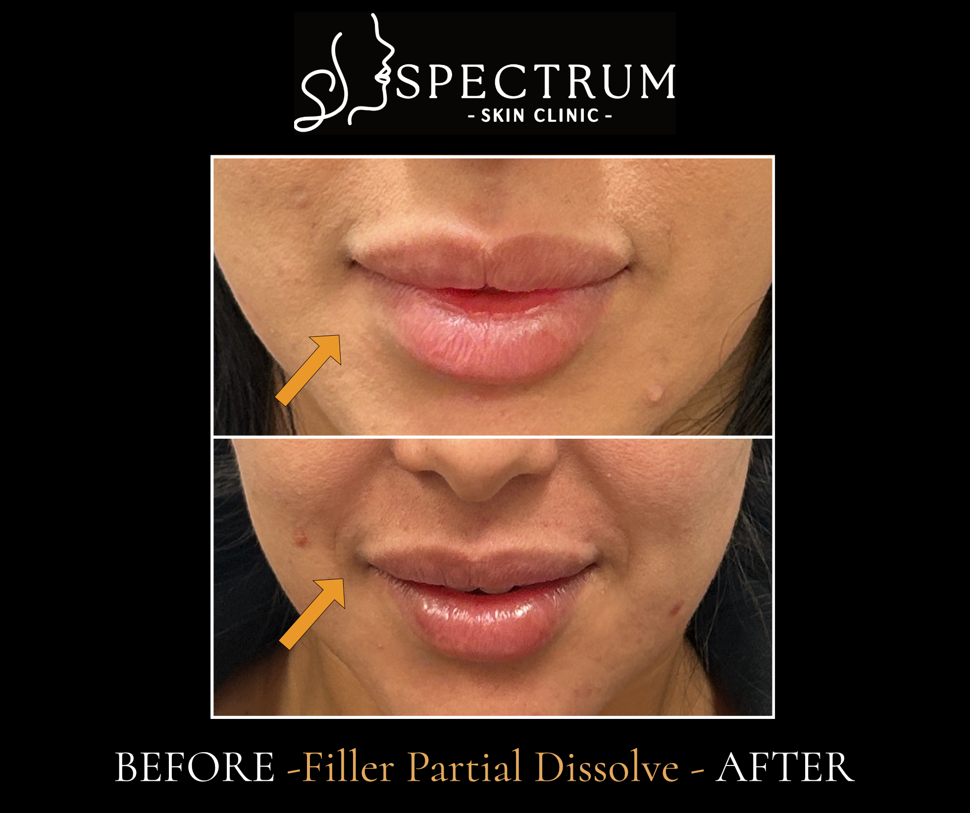 Lip Filler Partial Dissolve Before & After | Correcting Overfilled Lips