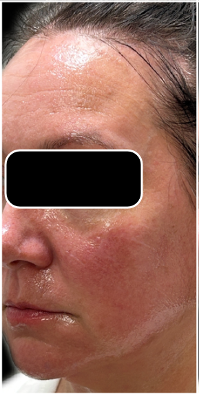 Light & Bright IPL before — Sun Damage, Hyperpigmentation, Facial Redness, Uneven Skin Tone, front view