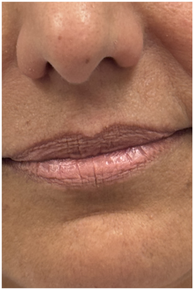 Lip Filler before — Perioral Aging, Lip Lines, Uneven Texture, front view