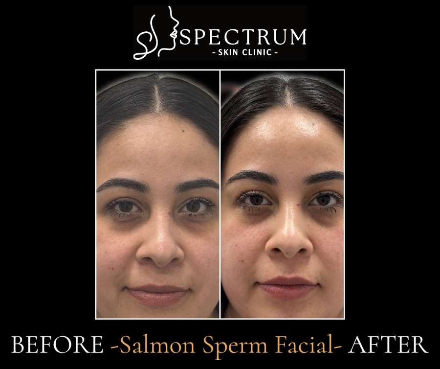 Salmon DNA Facial Before and After | Hydration and Brightness
