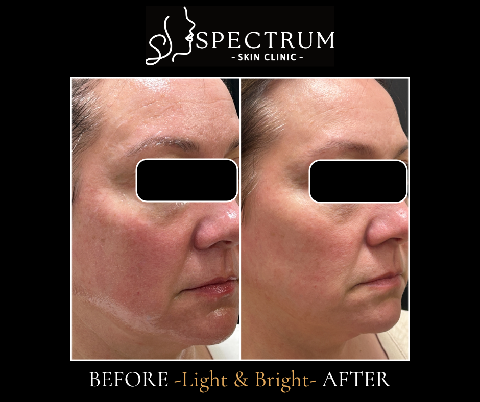 Light & Bright IPL Before & After | Brighter, Clearer Skin