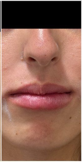 Lip Filler after — Lip Volume, Lip Symmetry, Lip Definition, front view