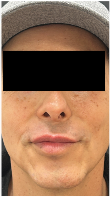 Lip Filler after — Thin Lips, front view
