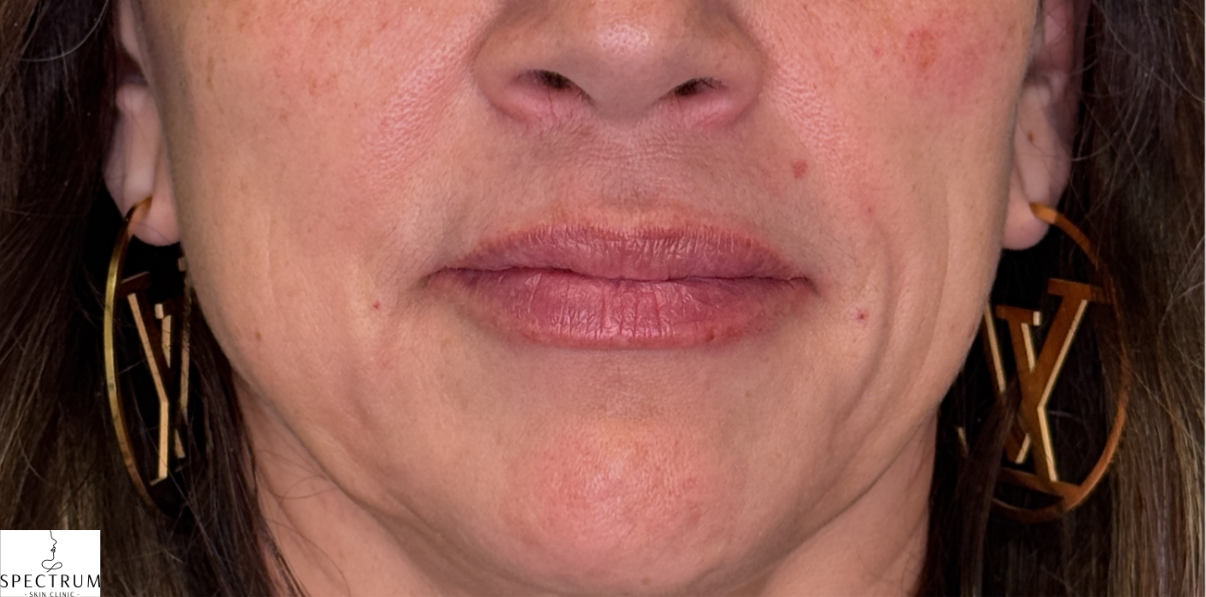 Lip Filler after — Volume and Definition, front view