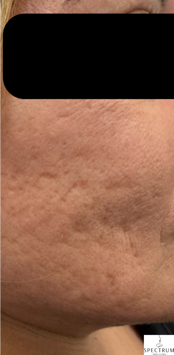 RF Microneedling, TCA CROSS Peel before — Acne Scars, Uneven Texture, Boxcar Scars, Rolling Scars, front view