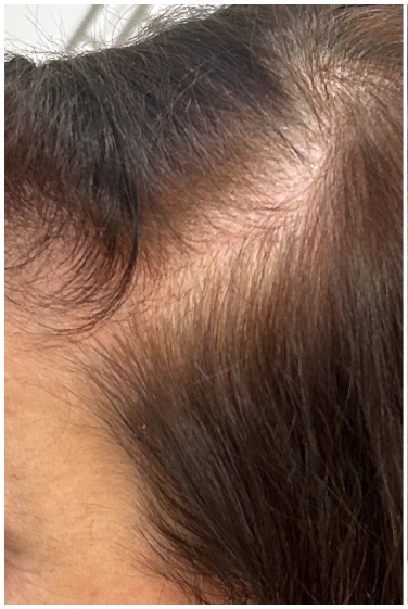 PRFM Hair Therapy before — Focal Density Loss, Hair Thinning, Reduced Scalp Coverage, front view