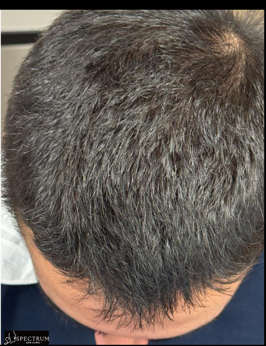 Exosome Therapy after — Crown Thinning, Chronic Hair Shedding, front view