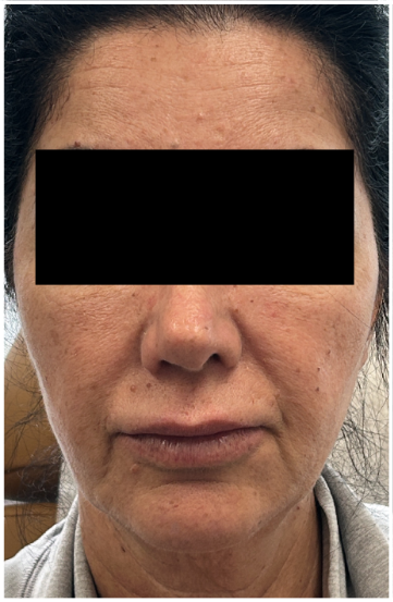 Cheek Filler, Facial Balancing before — Midface Volume Loss, Sagging and Laxity, Nasolabial Folds, Lower Face Sagging, front view