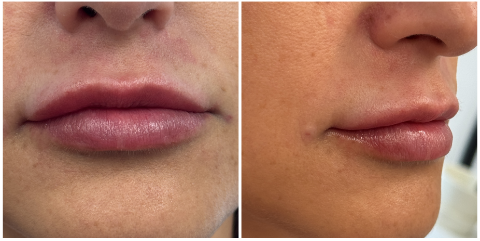 Lip Filler after — Thin Lips, front view