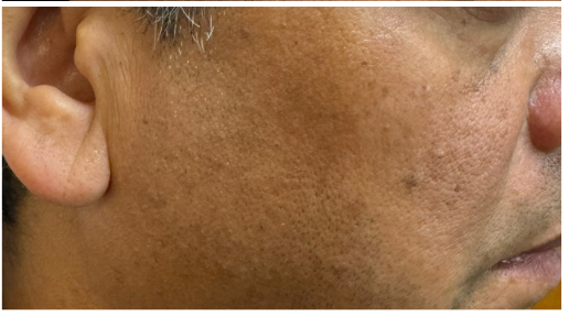 Pico Laser after — Hyperpigmentation, Sun Damage, Brown Spots, Solar Lentigines, front view
