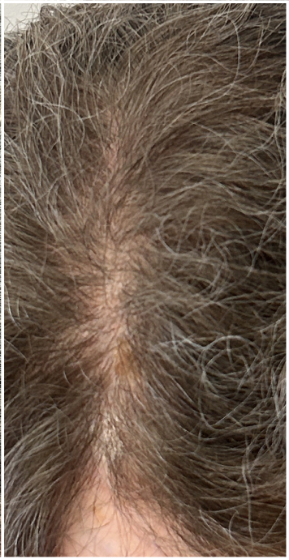 Exosome Hair Therapy after — Female Pattern Hair Loss, Crown Thinning, Central Part Widening, front view