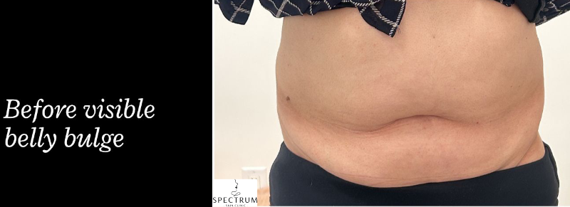 Body Cavitation after — Localized Fat, Body Contouring, Thigh Fat, Hip Fat, front view