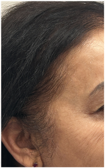PRFM Hair Restoration after — Temporal Recession, Receding Hairline, Reduced Density at Temples, front view