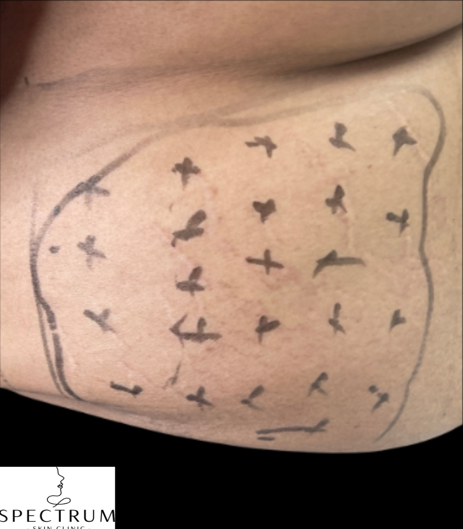 Kybella before — Double Chin, Submental Fullness, Submental Fat, front view