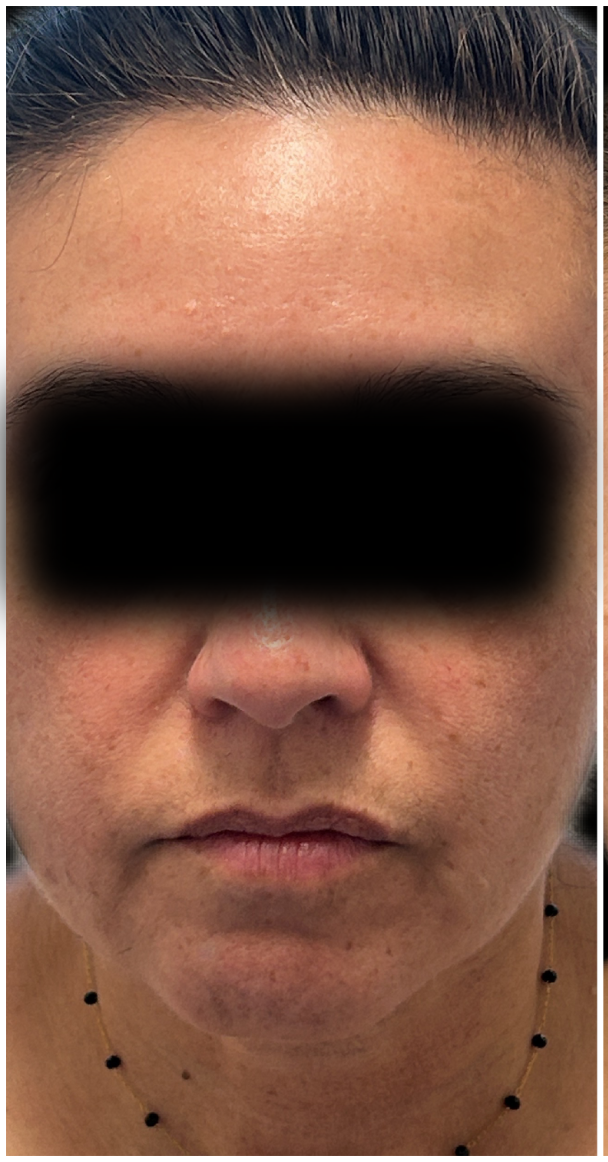 IPL Photofacial, Nordlys IPL before — Rosacea, Facial Redness, Hyperpigmentation, Sun Damage, Visible Vessels, front view