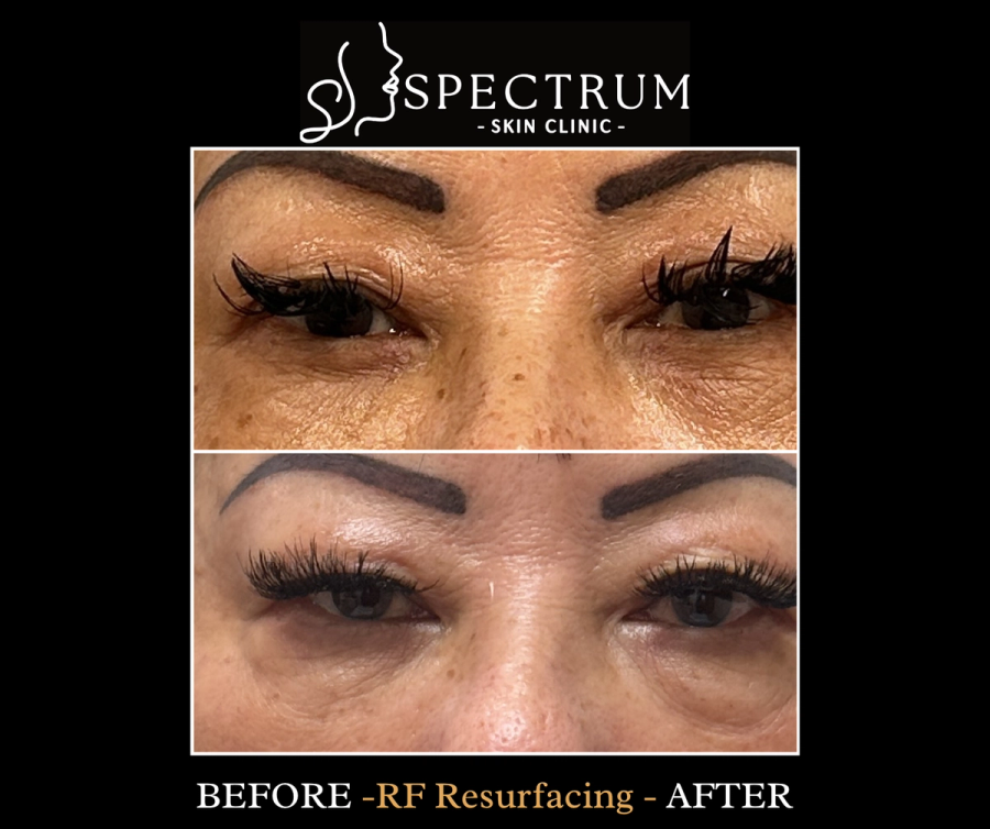 RF Resurfacing Under Eye Before & After, Skin Tightening and Brightening at Spectrum Skin Clinic, Irvine