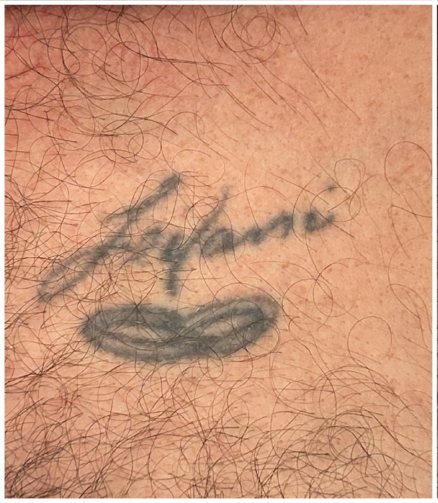 Pico Laser, Tattoo Removal before — Unwanted Tattoo, Tattoo Fading, Tattoo Removal, front view