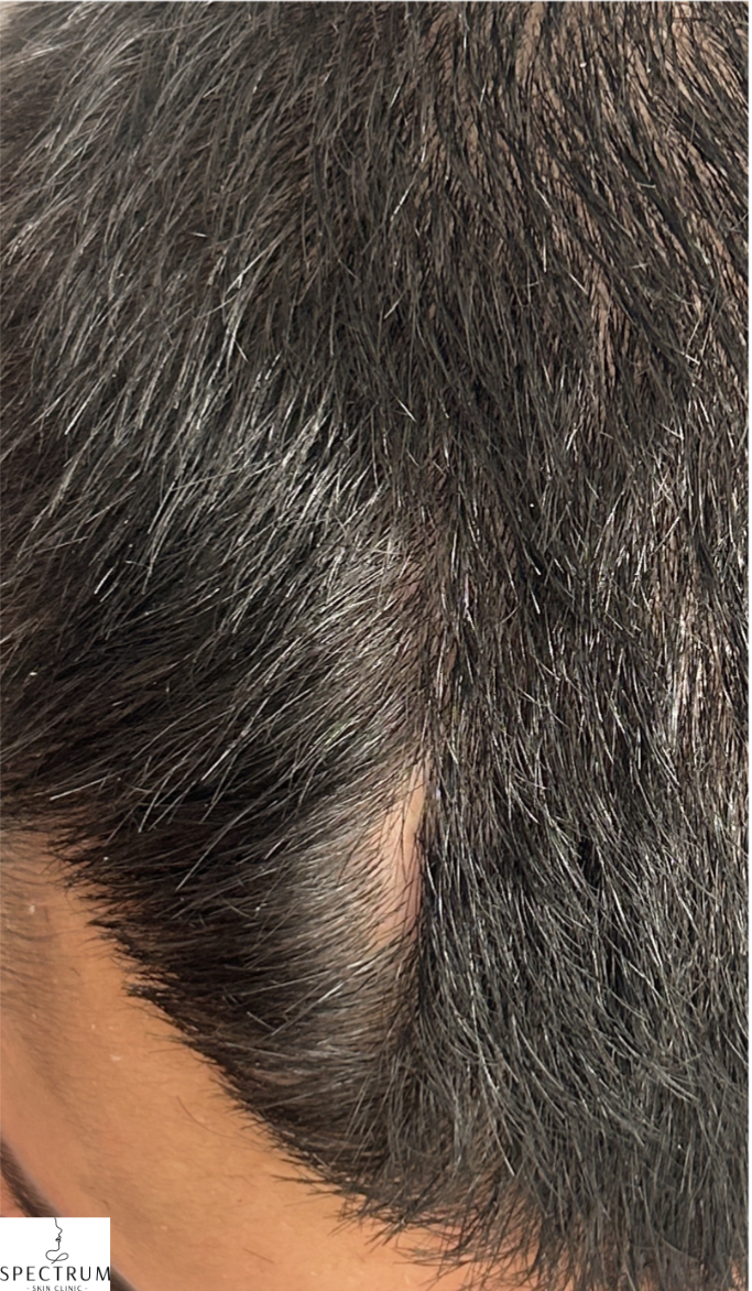 Exosome Therapy before — Hair Thinning, Part Line Thinning, front view