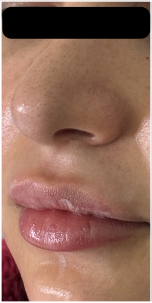 Lip Filler Dissolve before — Uneven Texture, Filler Migration, front view