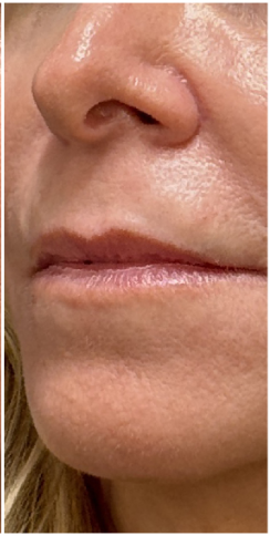 Lip Filler after — Thin Lips, Volume Loss, Lip Definition, Loss of Lip Border, front view