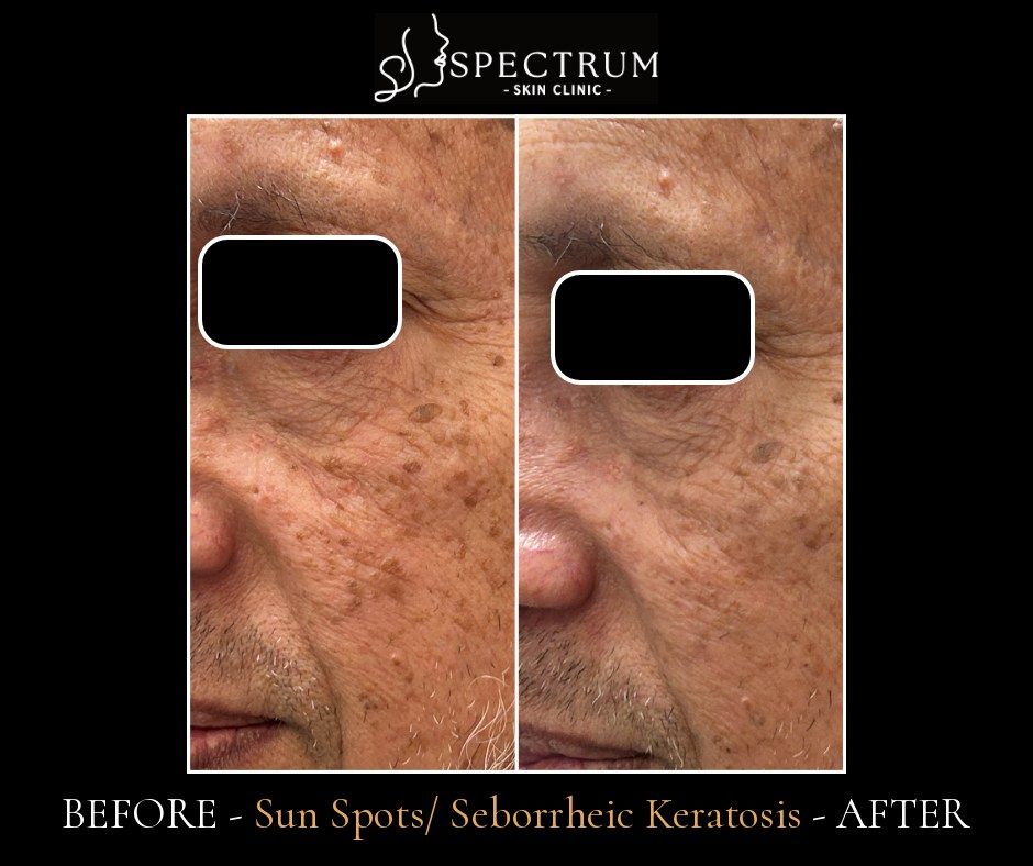 Q-Switch Laser Before & After | Sun Spots and Seborrheic Keratosis
