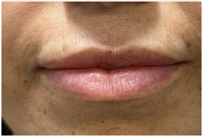 Lip Filler after — Thin Lips, Perioral Aging, Lip Lines, Fine Lines, Wrinkles, front view